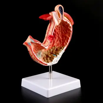 Inson Anatomik Anatomiyasi Oshqozon Tibbiy Modeli Oshqozon Patologiyasi Gastrit Yarasi Tibbiy O'qitish Vositasi